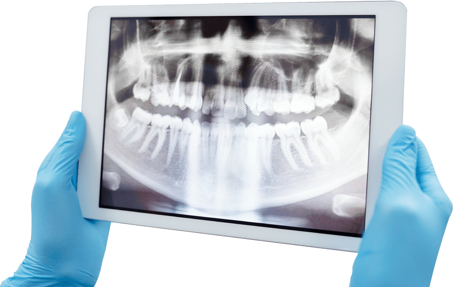 A computer screen showing an x-ray of teeth.